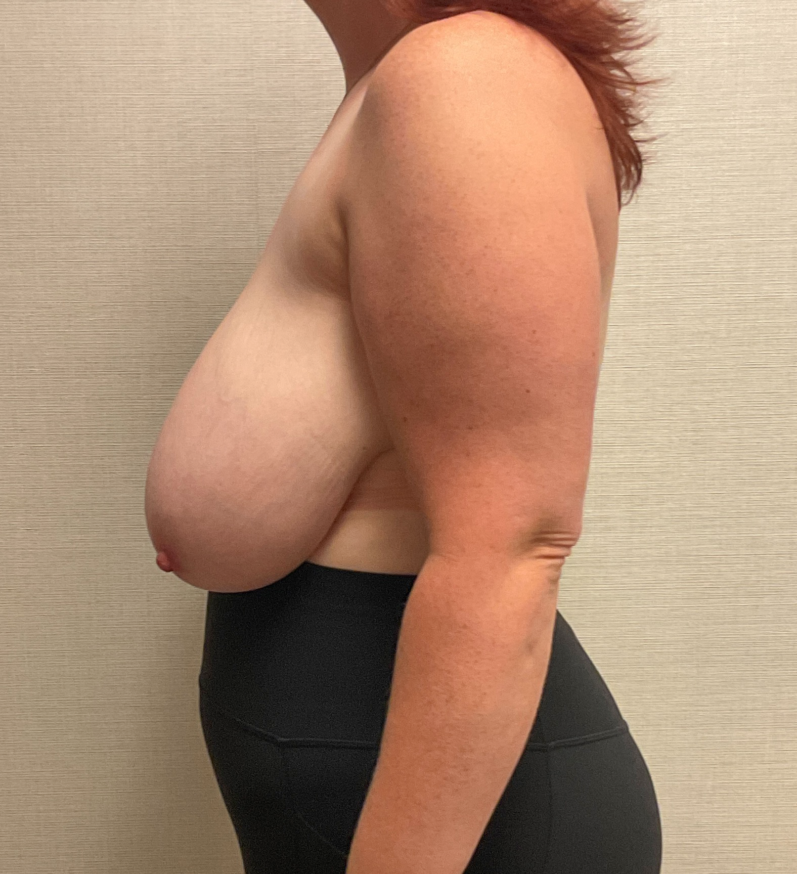 Breast-Reduction-Case--28338 | Before Breast 2