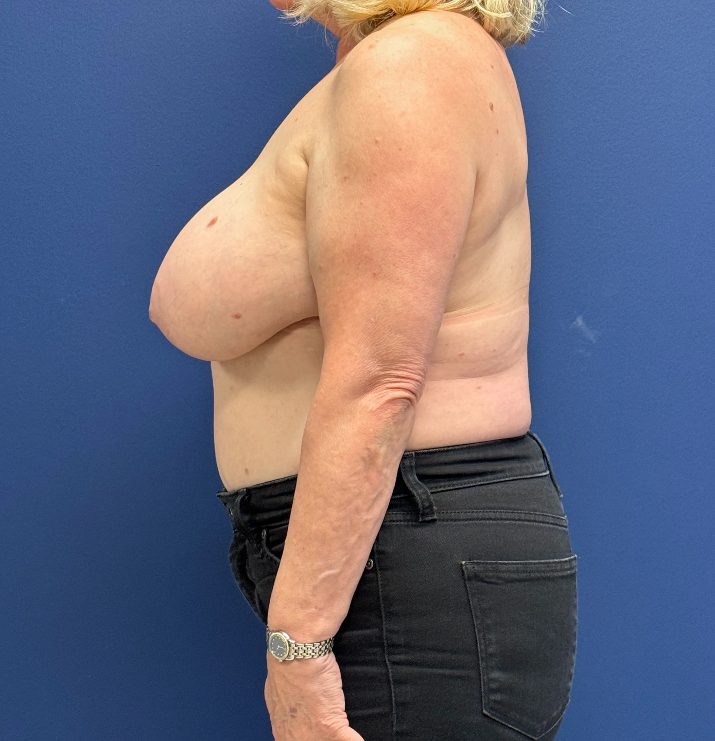 Breast-Reduction-Case--29091 | Before Breast 2