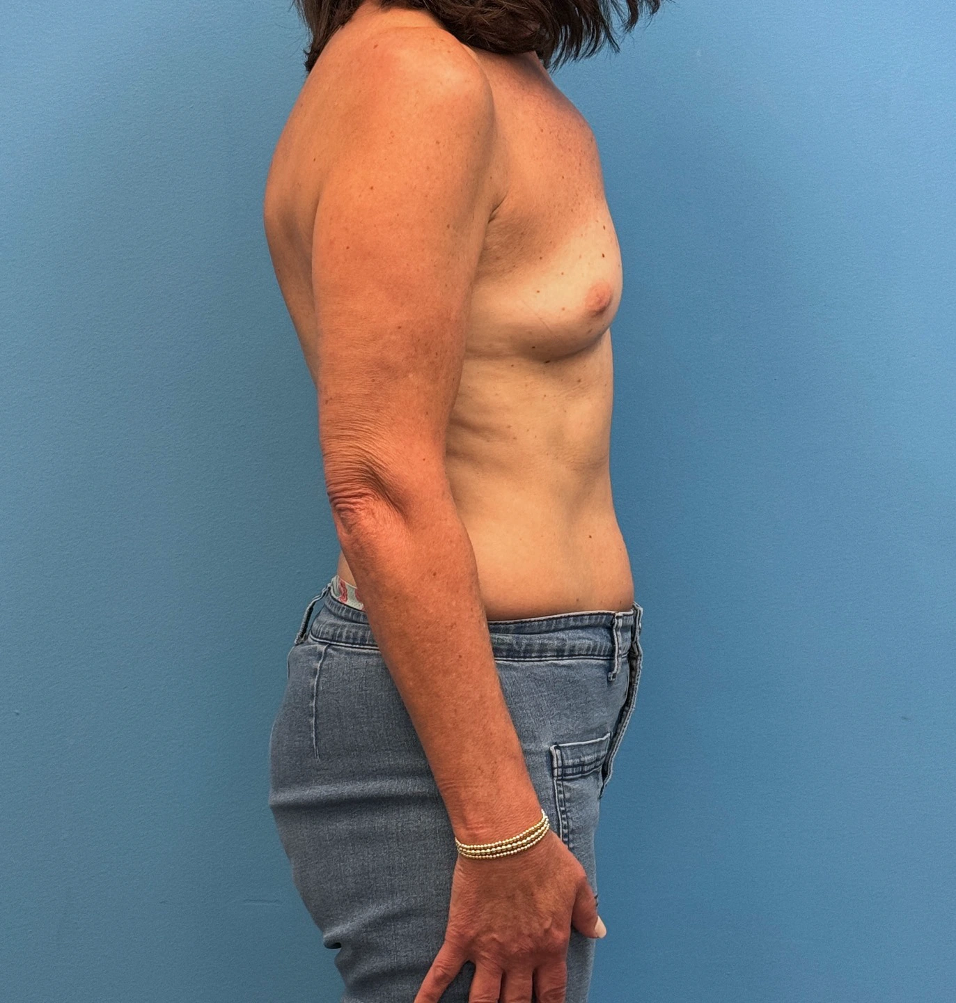 Breast-Reconstruction-Case--28688 | Before Breast 2