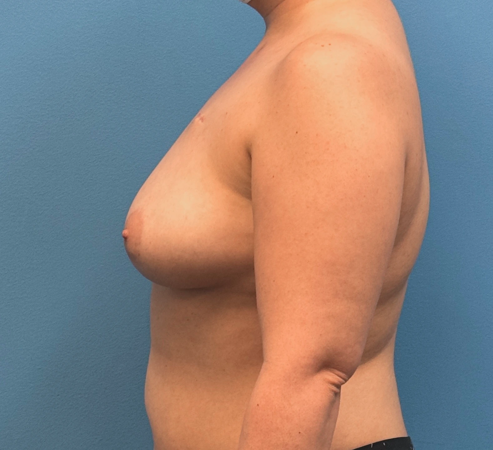 Breast-Reconstruction-Case--28689 | Before Breast 2