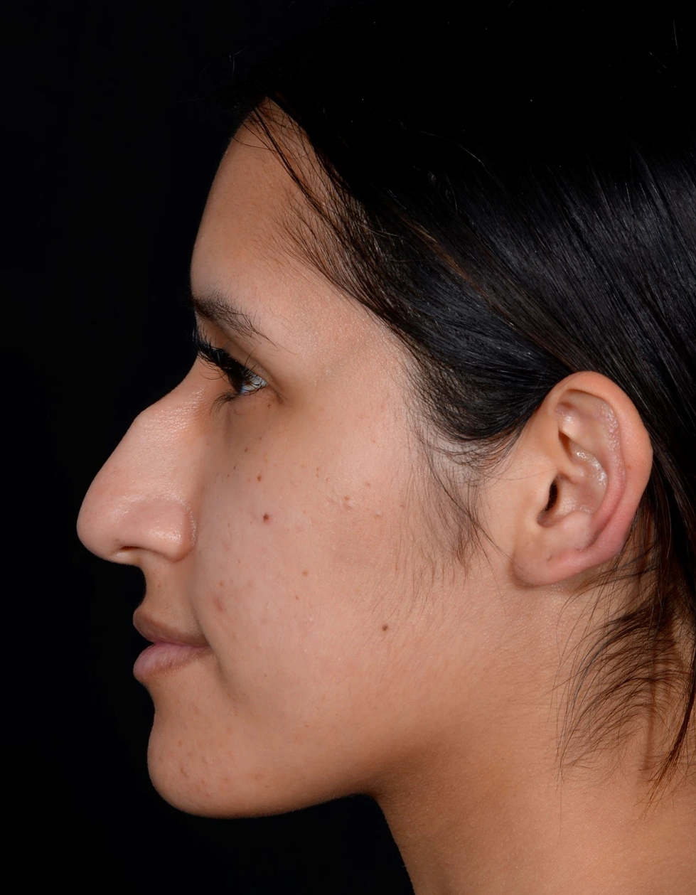 Rhinoplasty-Case--376 | Before Rhinoplasty 2