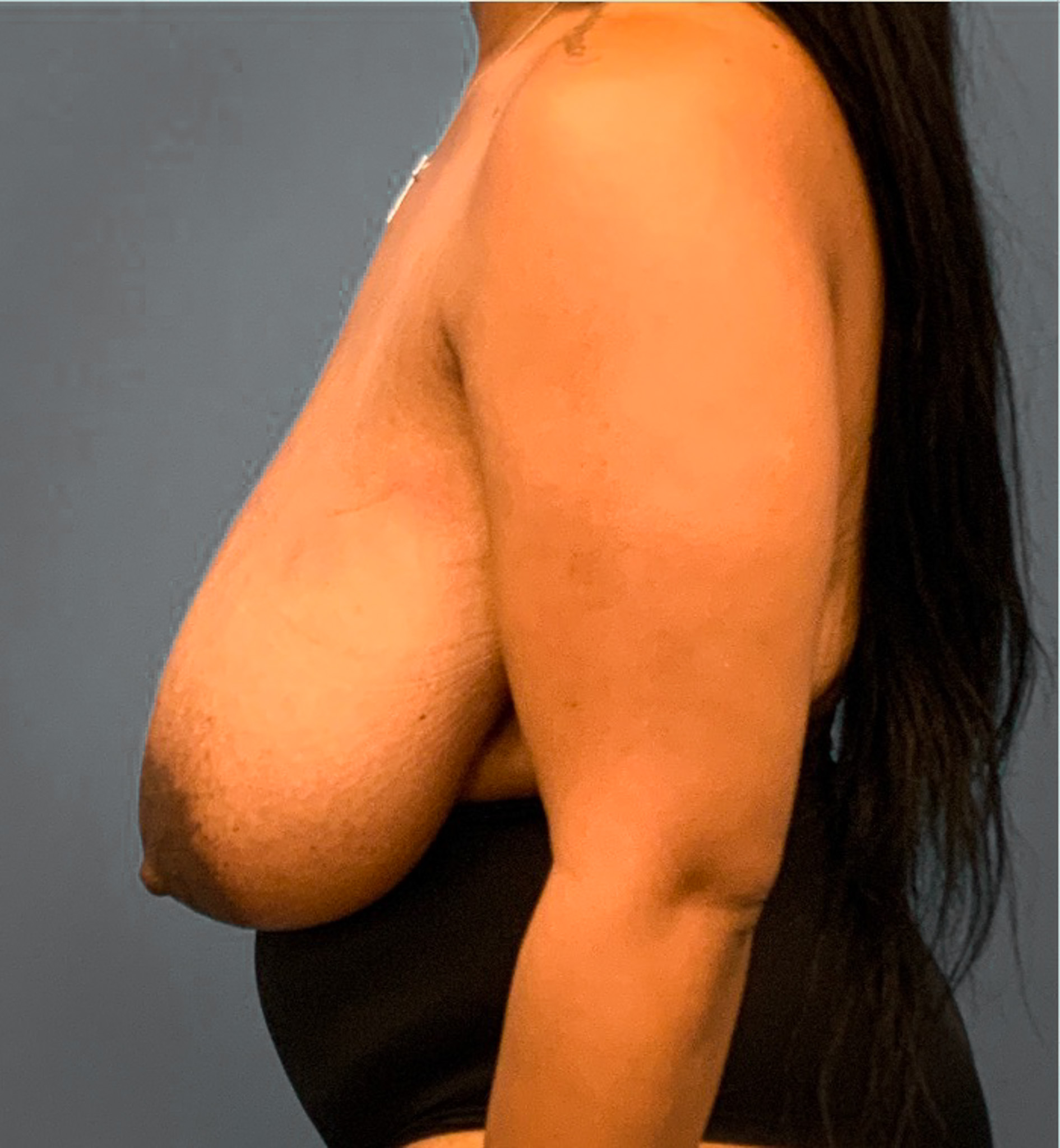 Breast-Reduction-Case--2564 | Before Breast 2