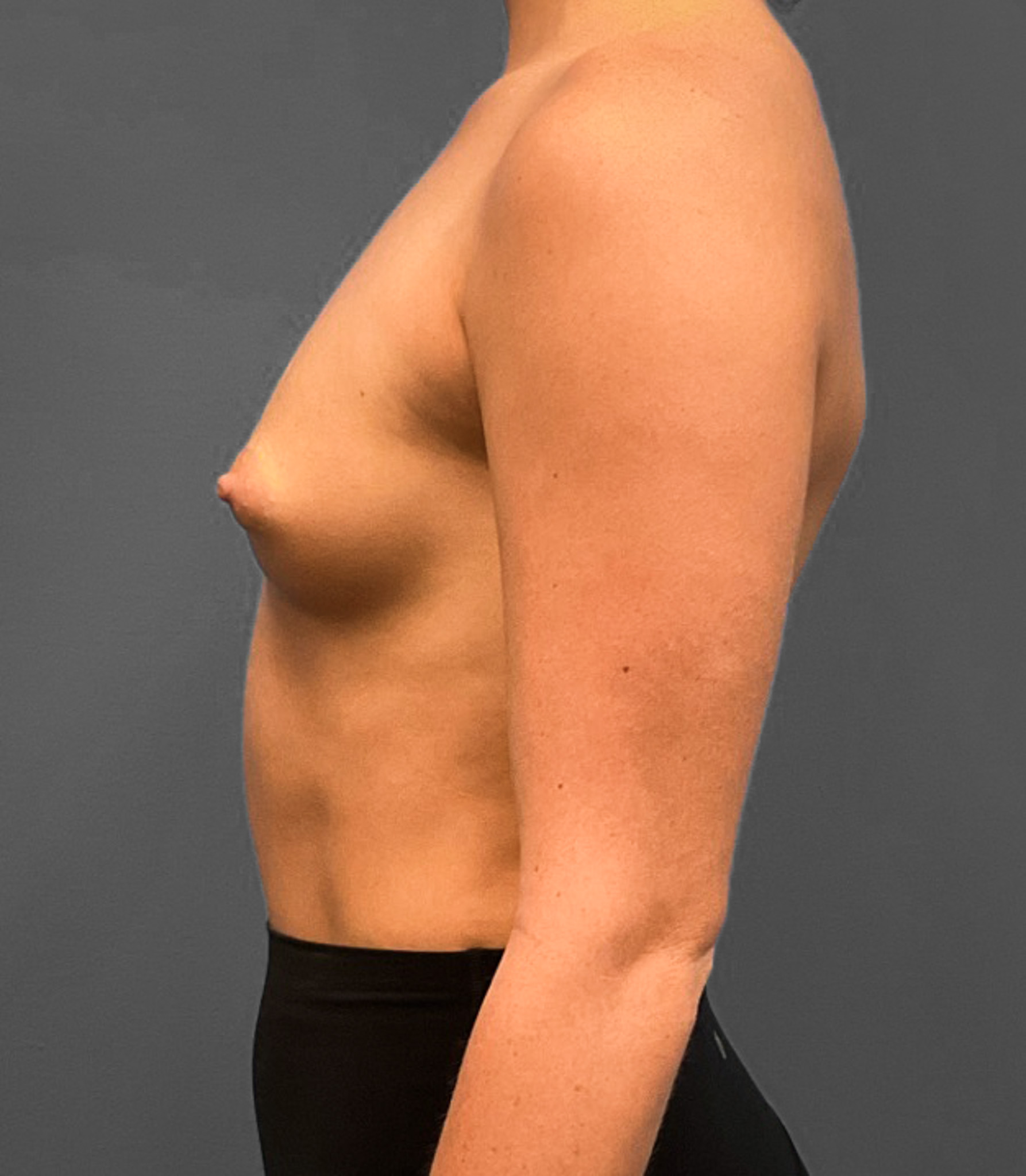 Breast-Augmentation-Case--2384 | Before Breast 2