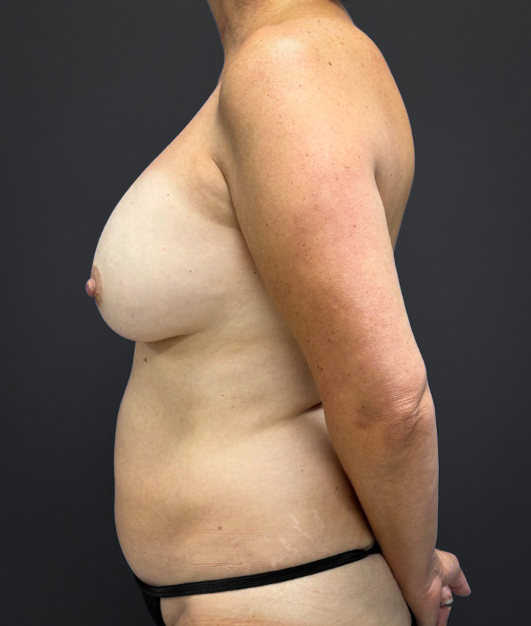 Mastopexy-Case--1663 | Before Breast 2