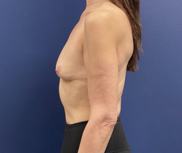 Subfascial-Breast-Augmentation-Case--26649 | Before Breast 2