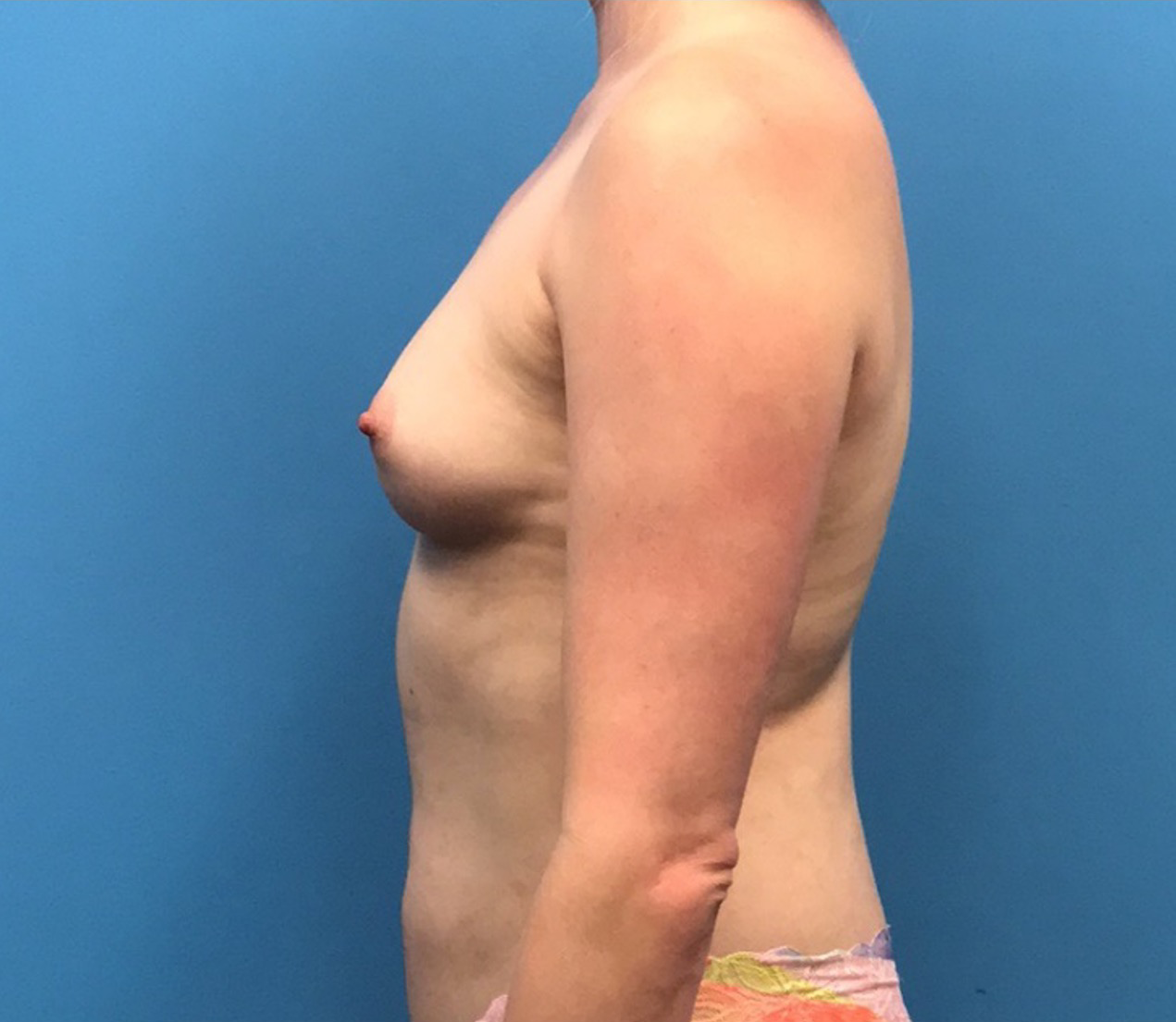 Breast-Augmentation-Case--219 | Before Breast 2