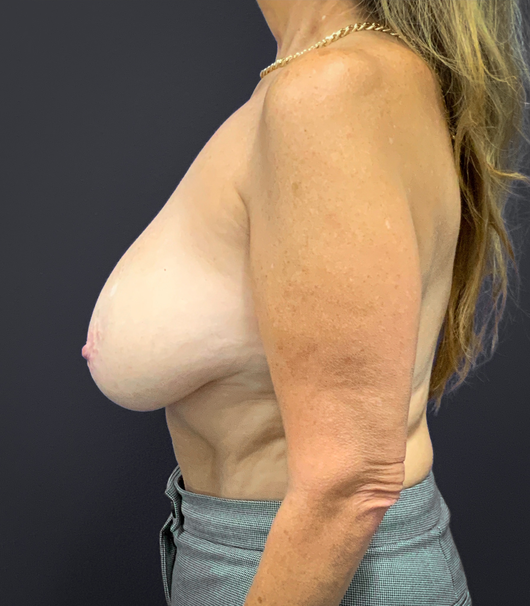 Breast-Reduction-Case--2538 | Before Breast 2