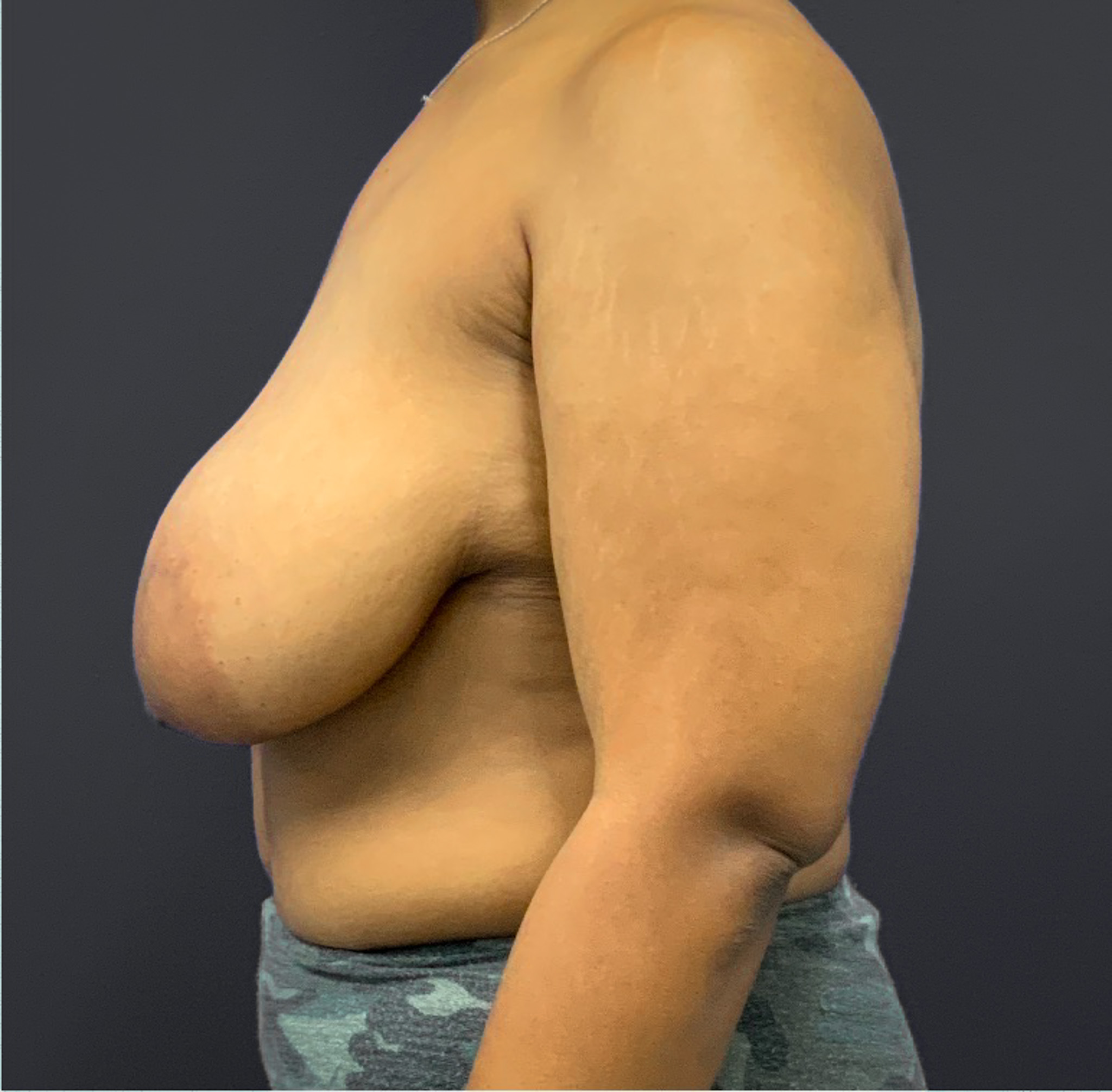 Breast-Reduction-Case--5320 | Before Breast 2