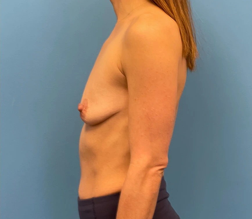 Breast-Augmentation-Mastopexy-Case--25025 | Before Breast 2
