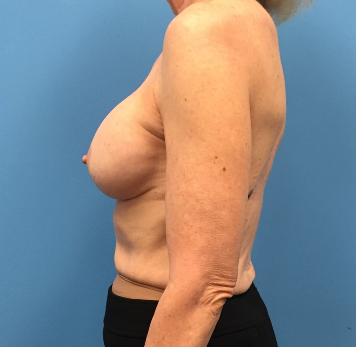 Revision-Breast-Augmentation-Case--237 | Before Breast 2