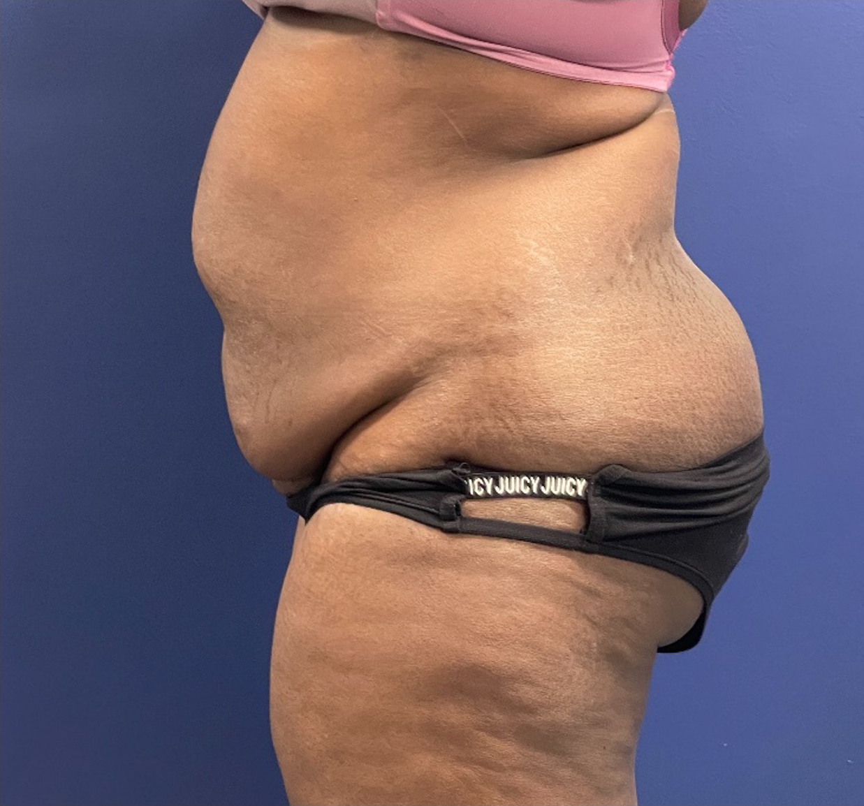 Case--257 | Before Tummy Tuck 2