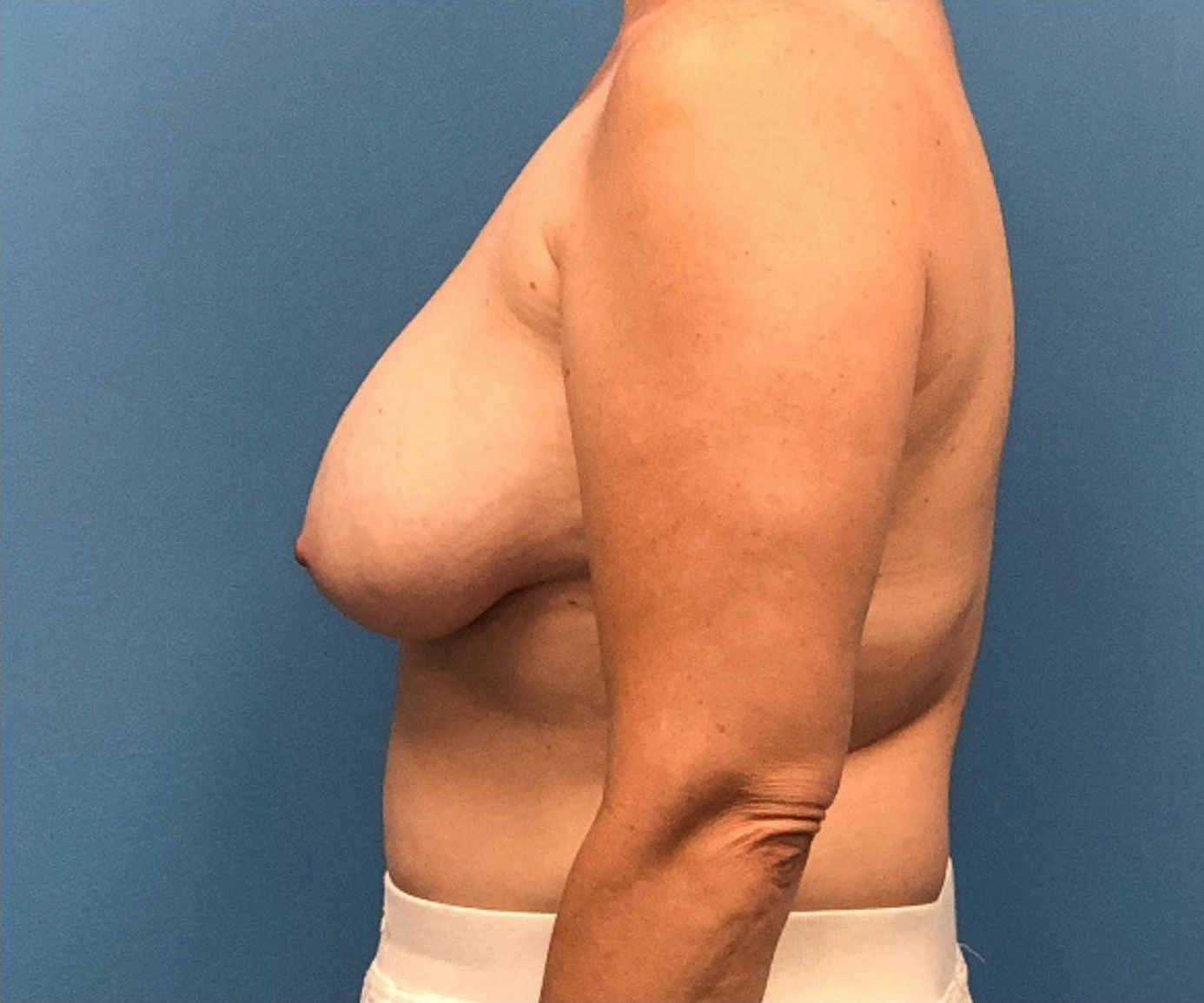 Breast-Reconstruction-Case--308 | Before Breast 2