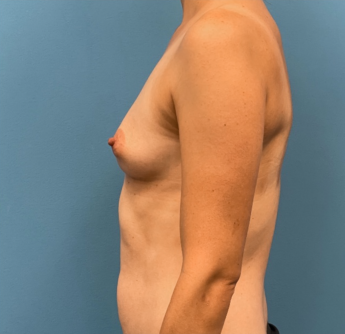 Breast-Reconstruction-Case--25209 | Before Breast 2