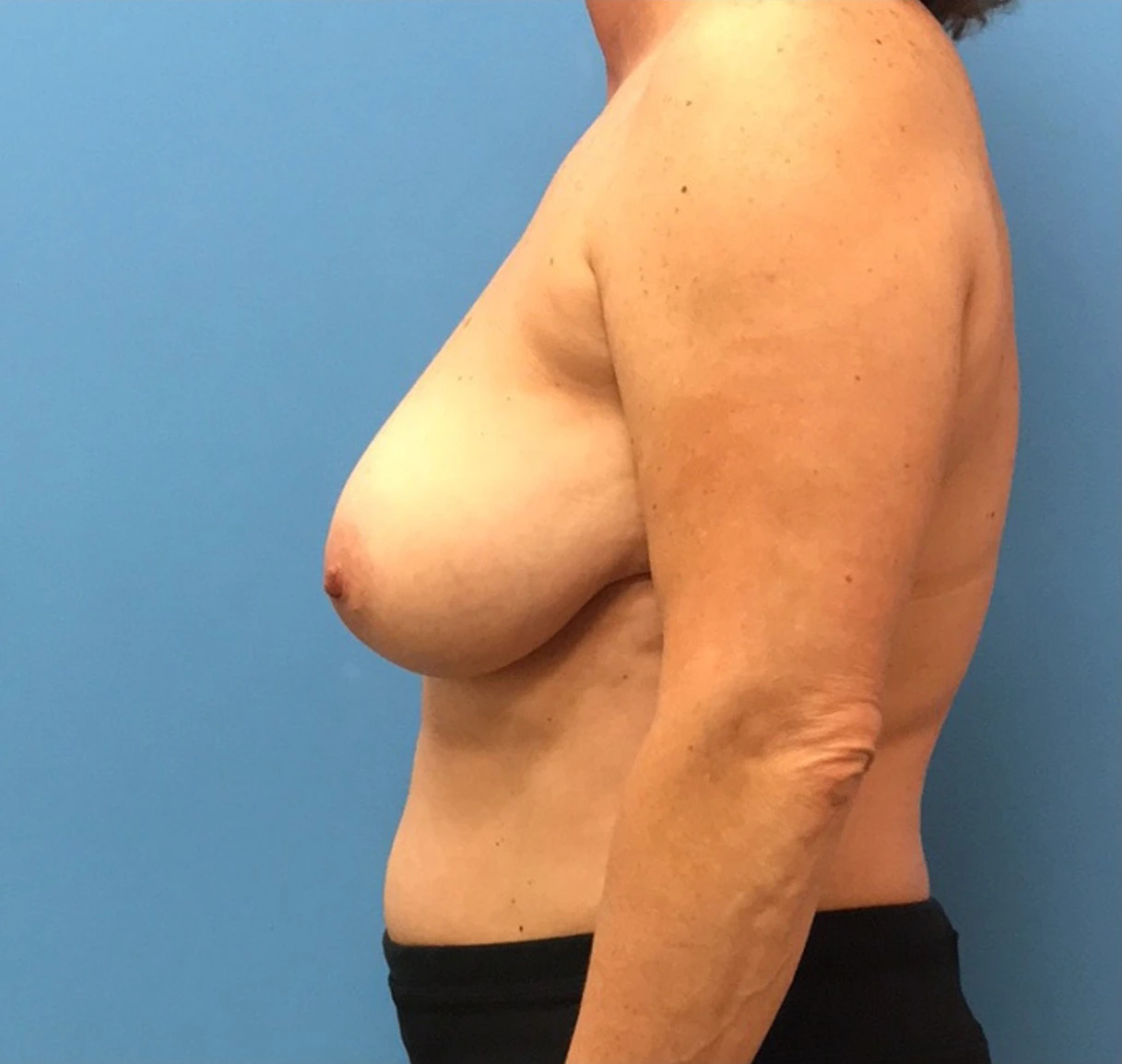 Case--314 | Before Breast 2