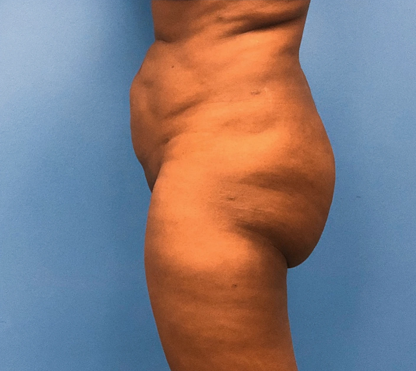 Brazilian-Butt-Lift-Case--267 | Before Brazilian Butt Lift 2