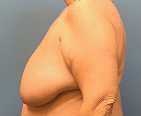 Breast-Reduction-Case--130 | Before Breast 2