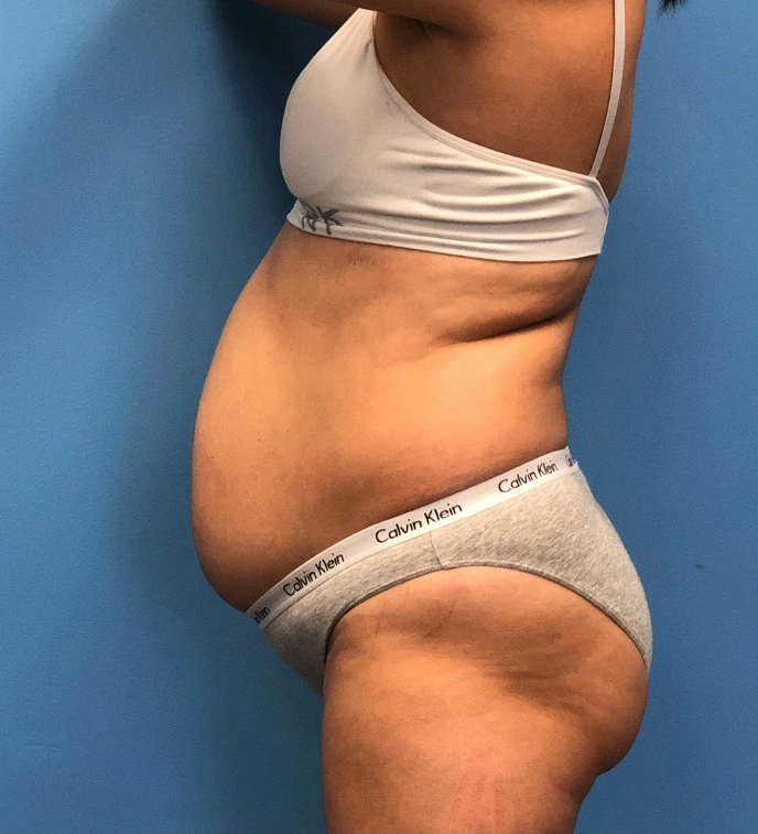 Case--14819 | Before Tummy Tuck 2