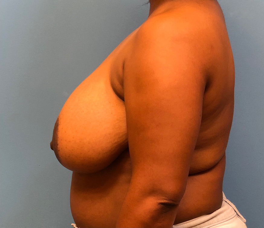 Breast-Reduction-Case--12894 | Before Breast 2