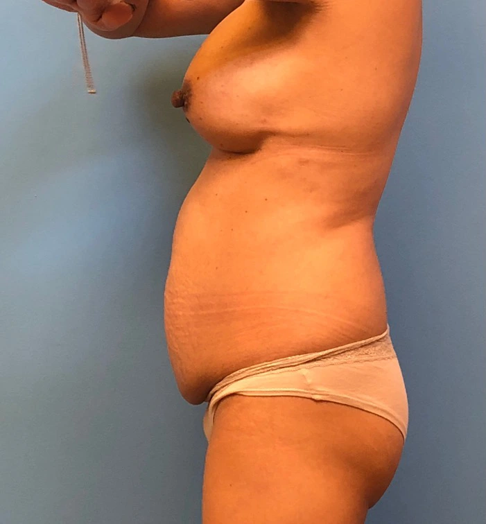 Case--11542 | Before Breast 2