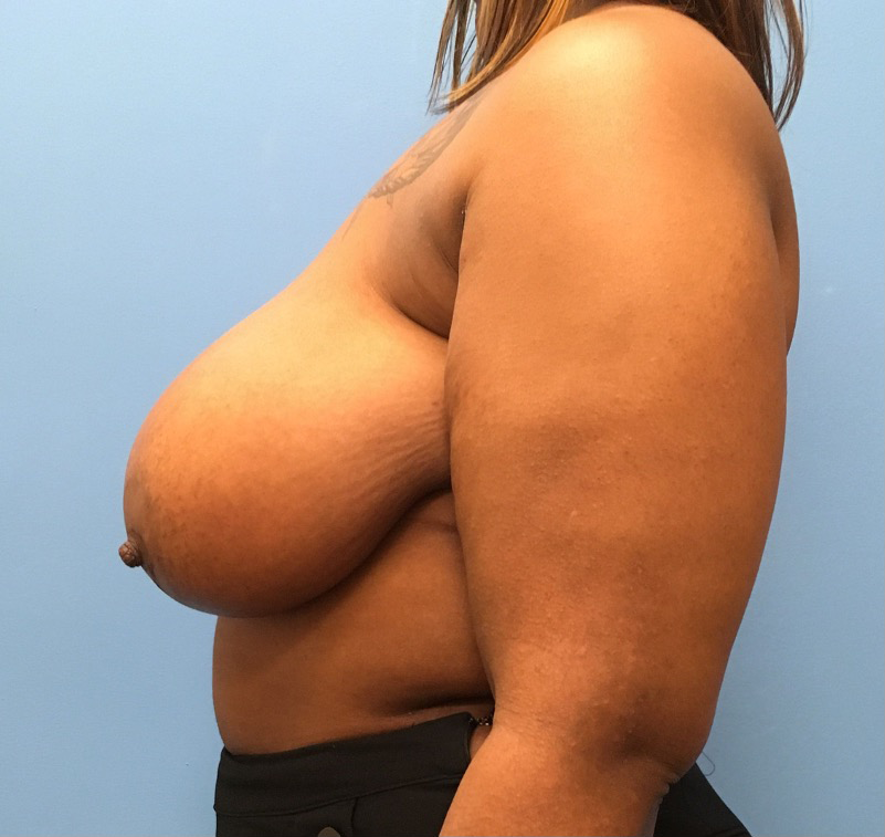 Breast-Reduction-Case--13002 | Before Breast 2