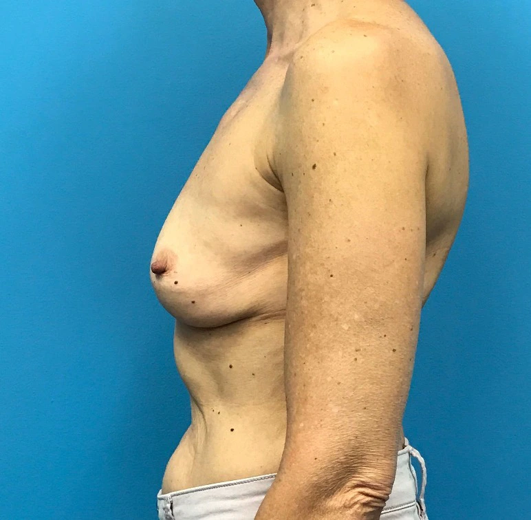 Revision-Augmentation--13287 | Before Breast 2