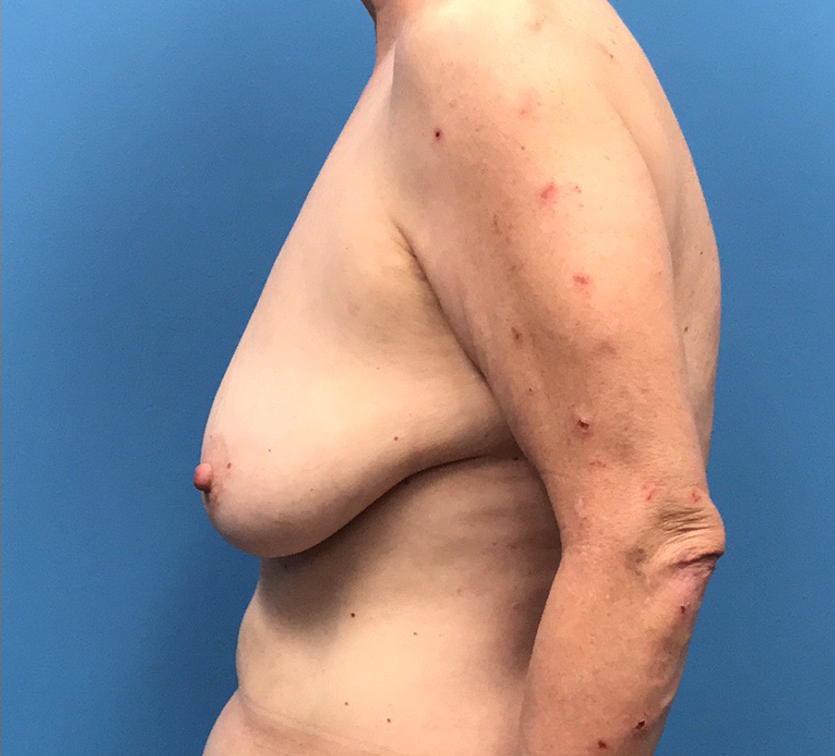 Case--10040 | Before Breast 2