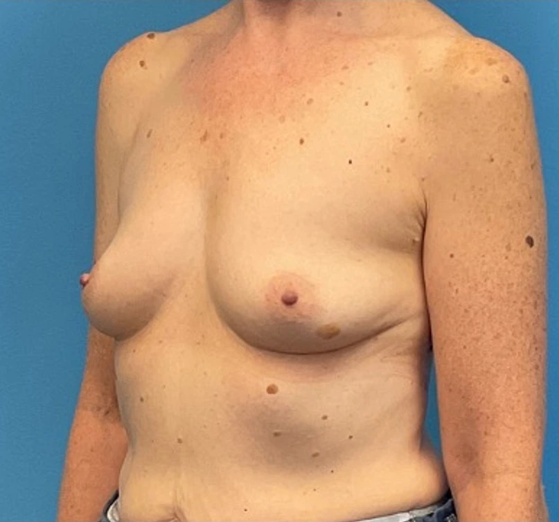 Breast-Augmentation-Case--27374 | Before Breast 2