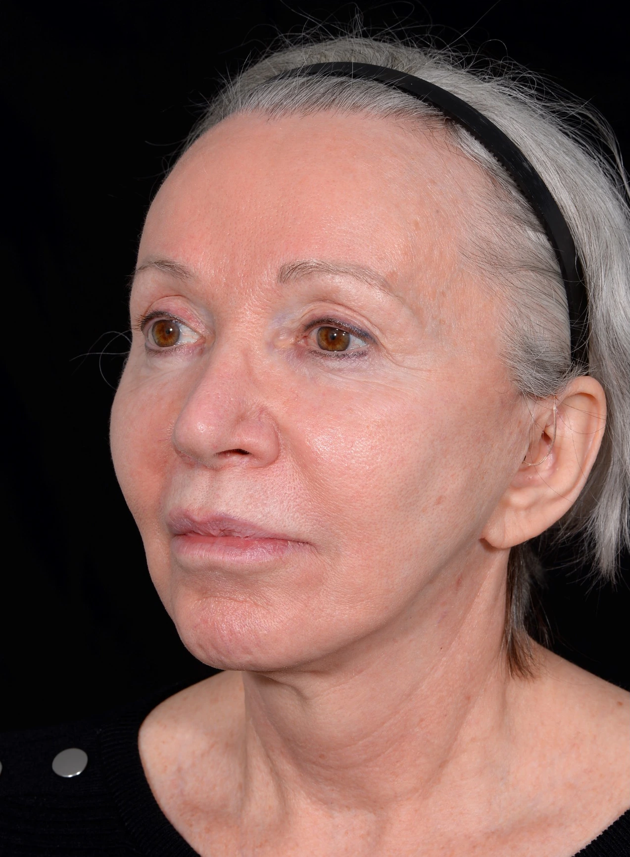 Facelift-Case--365 | Before Facelift 2