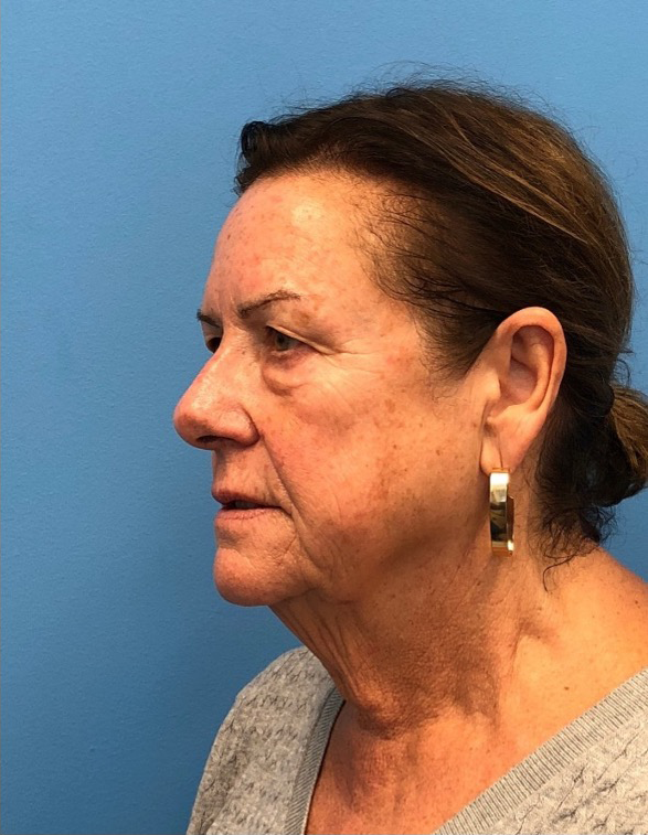 Facelift-Case--14406 | Before Eyelid Surgery 2