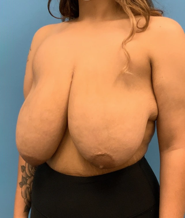 Breast-Reduction-Case--212 | Before Breast 2