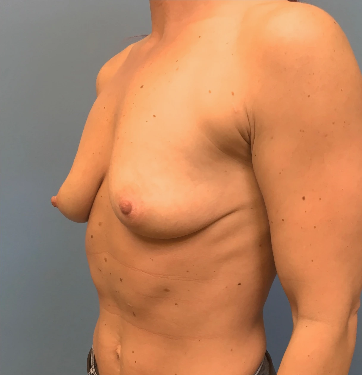 Case--17251 | Before Breast 2