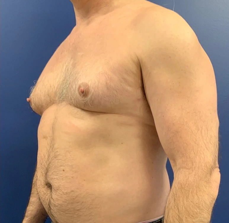 Gynecomastia-Case--20376 | Before Breast 2