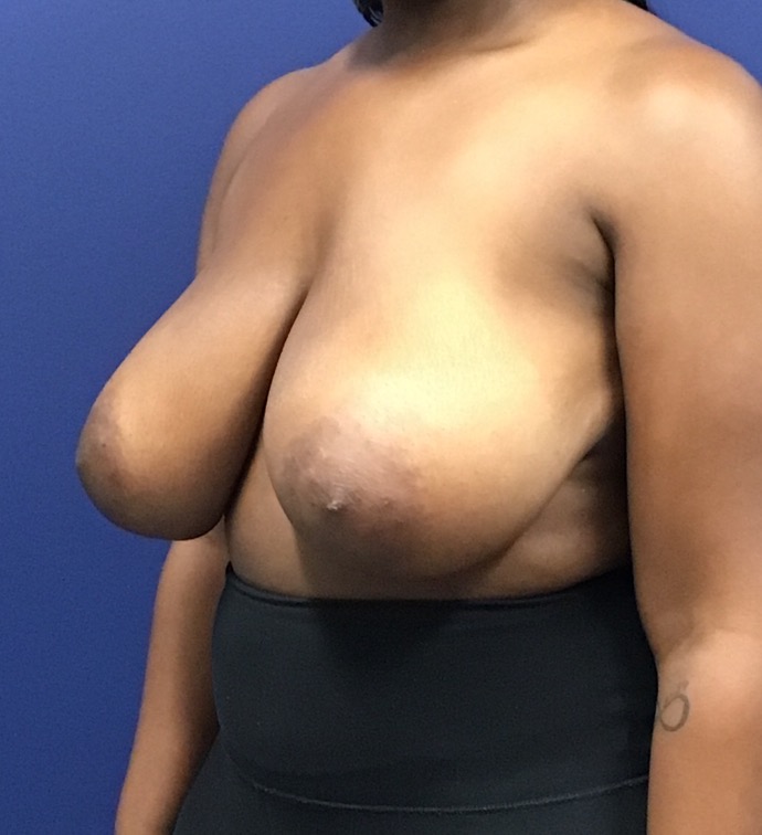 Breast-Reduction-Case--27530 | Before Breast 2