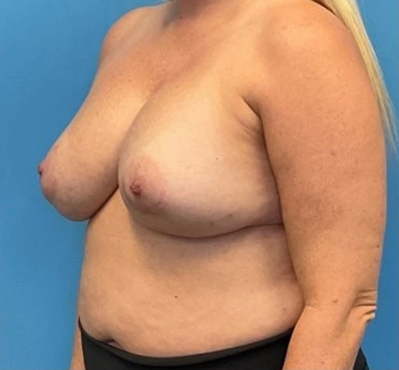 Breast-Reconstruction-Case--25682 | Before Breast 2