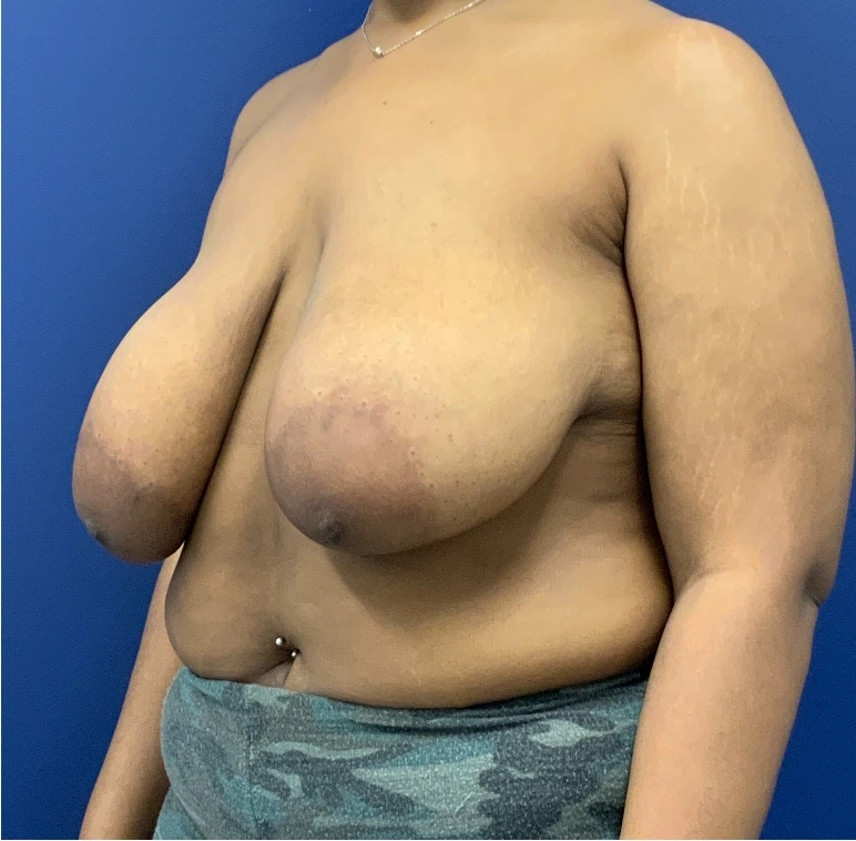 Breast-Reduction-Case--27281 | Before Breast 2