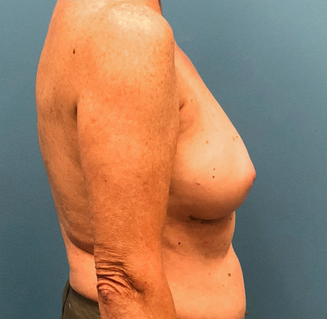 Case--13861 | Before Breast 2