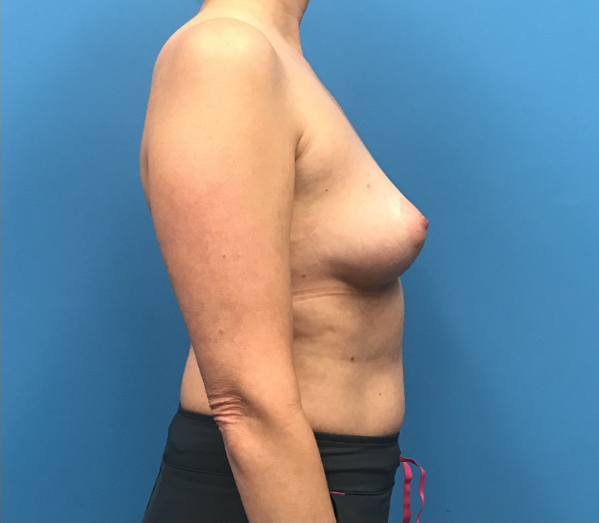 Case--12659 | Before Breast 2