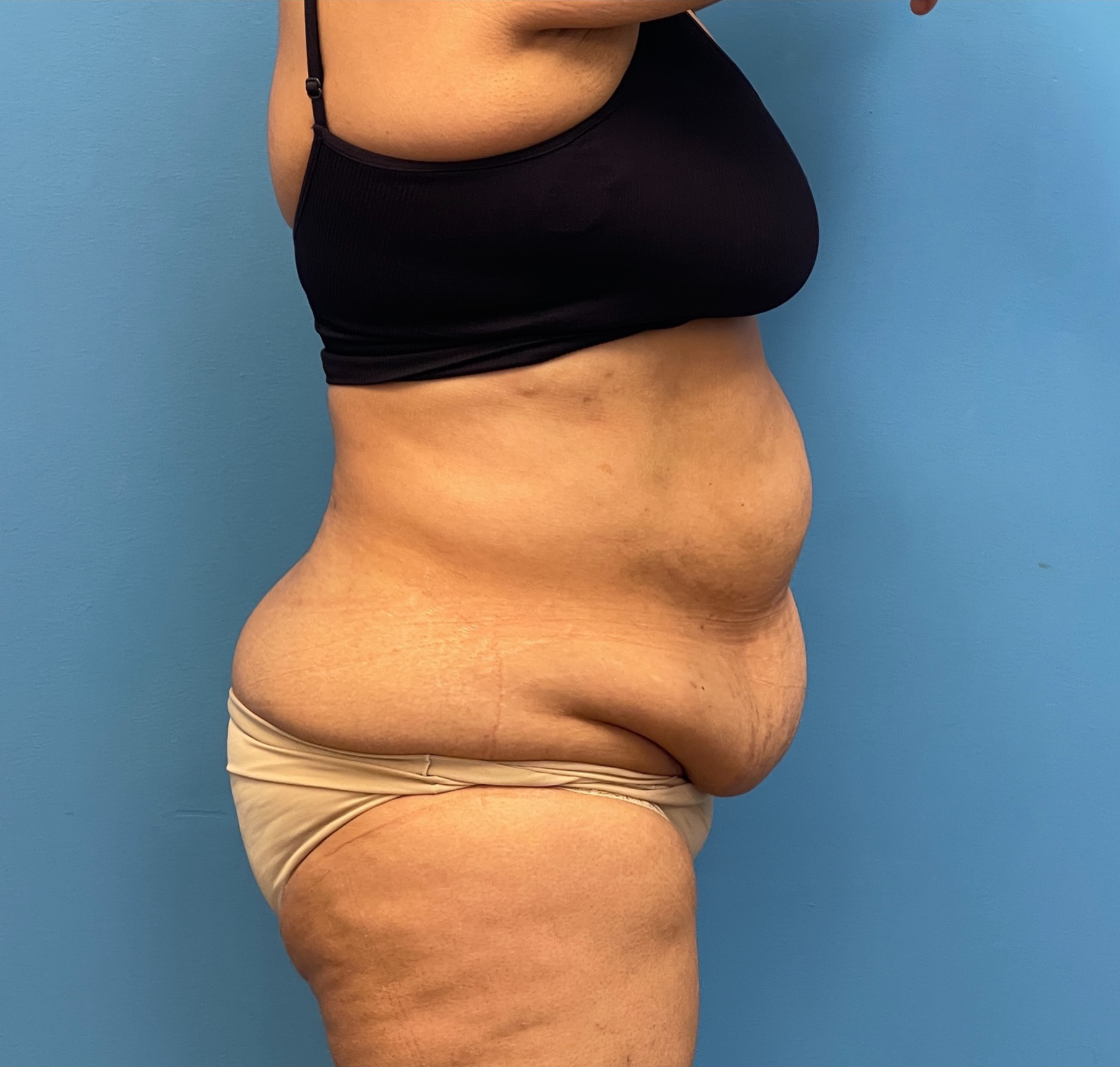 Lipoabdominoplasty-Case--27602 | Before Liposuction 3