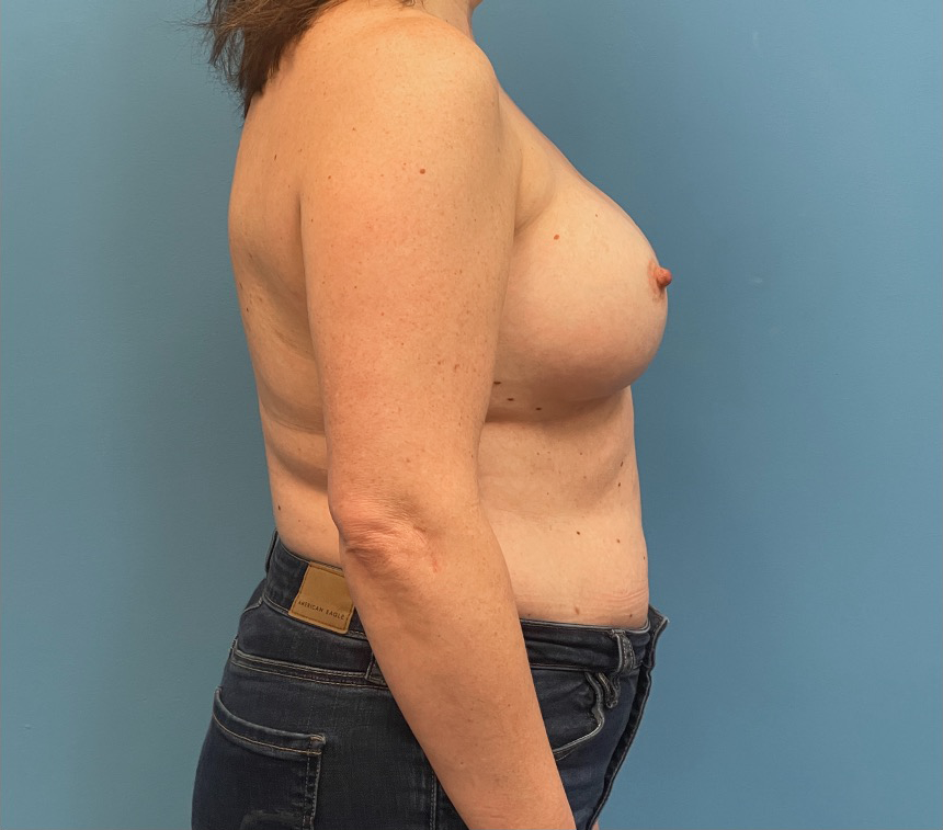 Breast-Reconstruction-Case--27065 | Before Breast 2