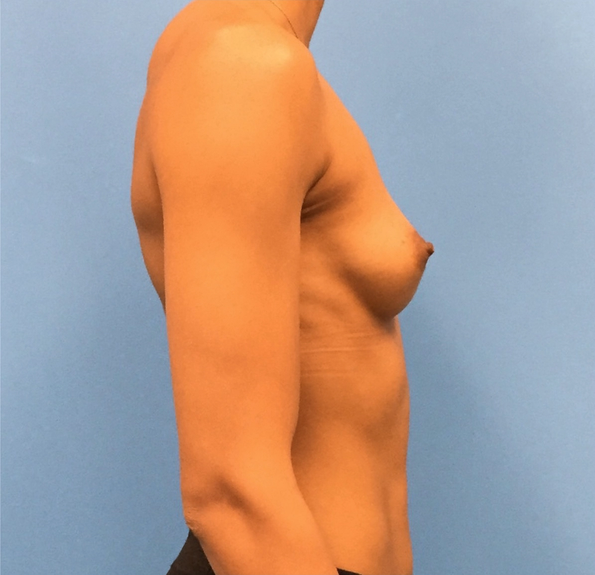 Breast-Augmentation-Case--221 | Before Breast 2