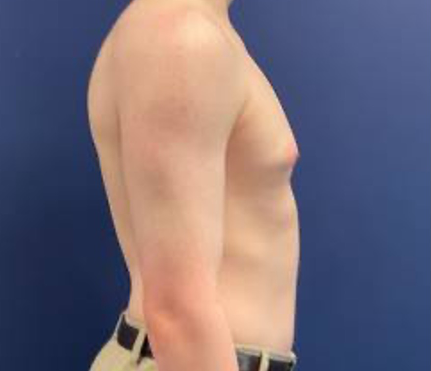 Gynecomastia-Case--214 | Before Breast 2