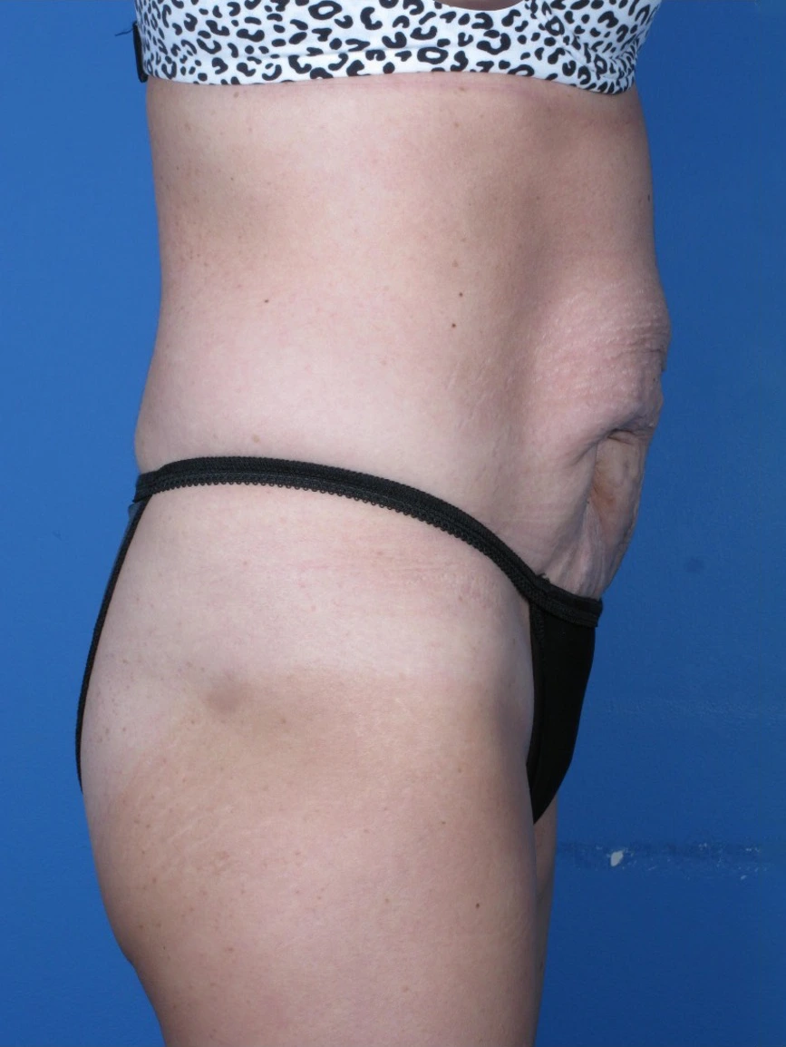 Tummy-Tuck-Case--250 | Before Tummy Tuck 2