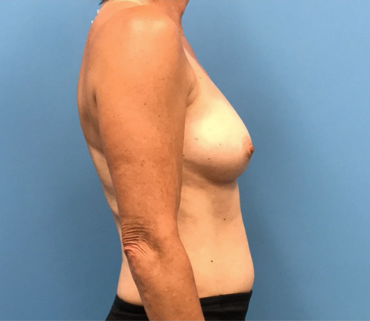 Breast-Reconstruction-Case--309 | Before Breast 2