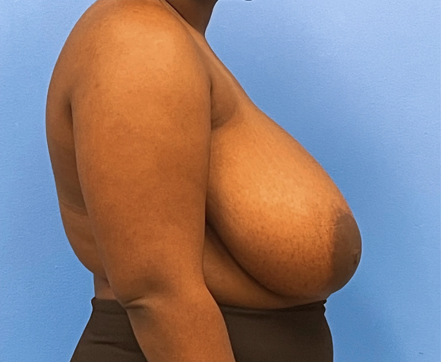 Breast-Reduction-Case--240 | Before Breast 2