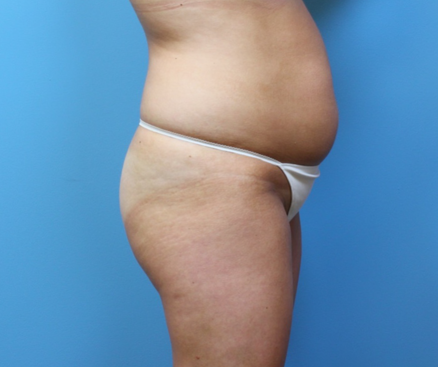 Brazilian-Butt-Lift-Case--265 | Before Brazilian Butt Lift 3