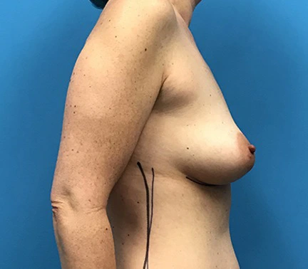 Case--96 | Before Breast 2