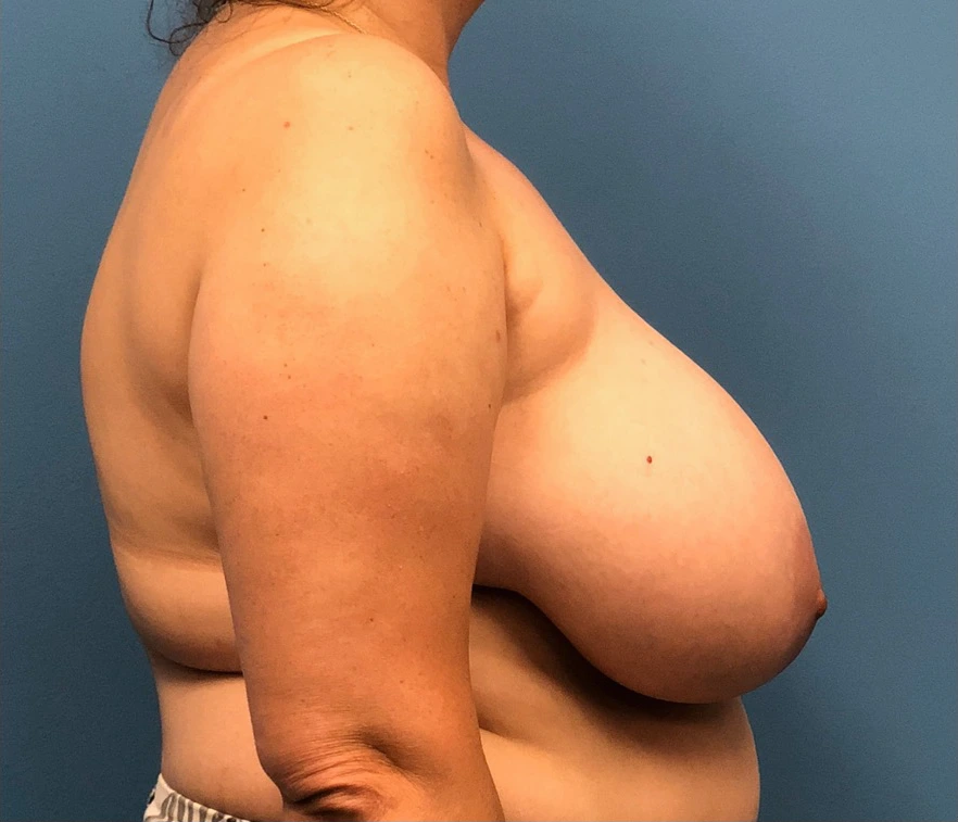 Breast-Reduction-Case--13597 | Before Breast 2