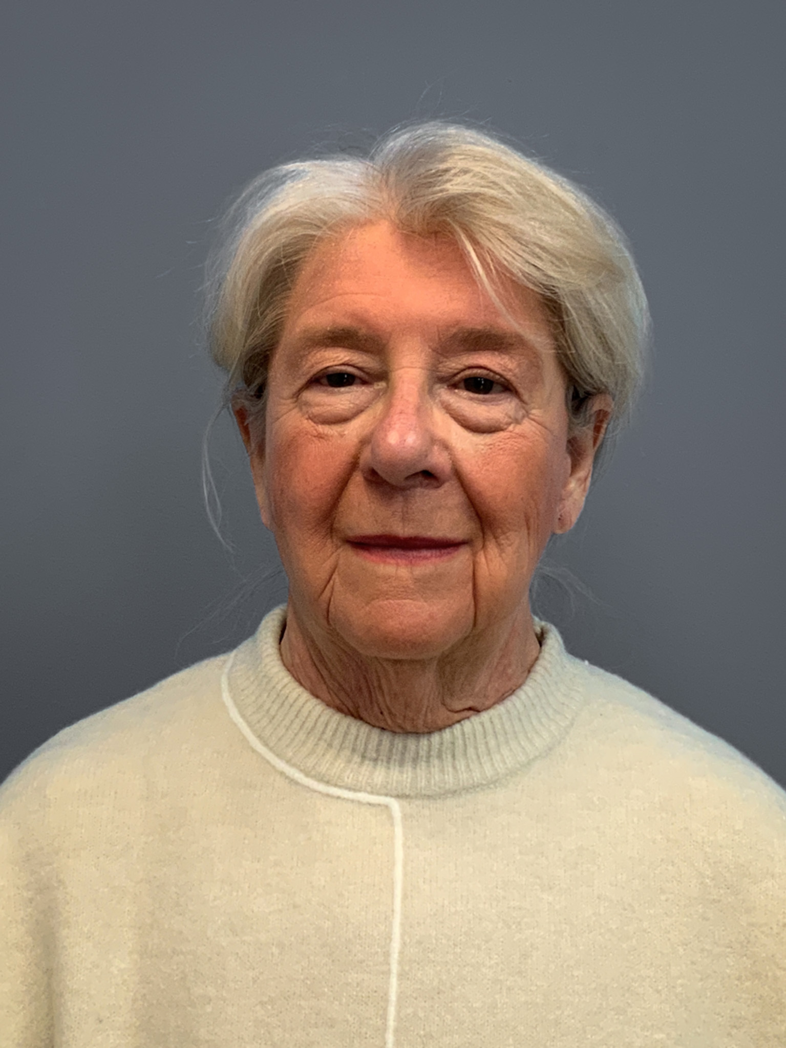 Facelift-360-Facial-Fat-Grafting-and-Necklift-Blepharoplasty-Case--1088 | Before Facelift 1