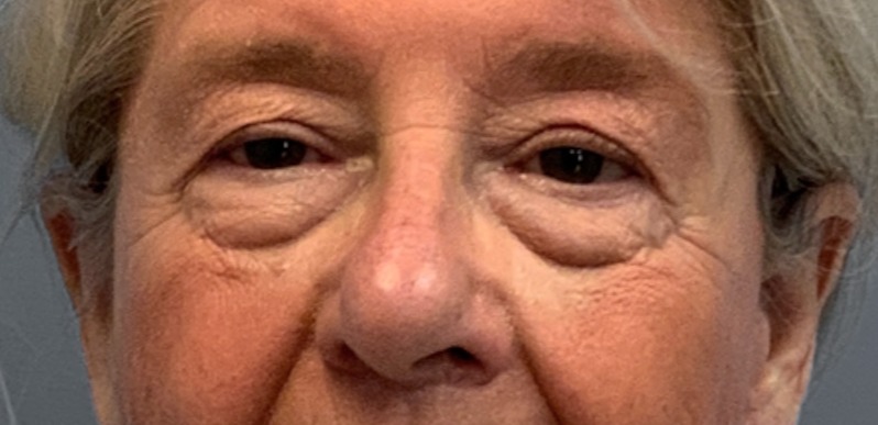 Blepharoplasty-Case--4349 | Before Eyelid Surgery 1