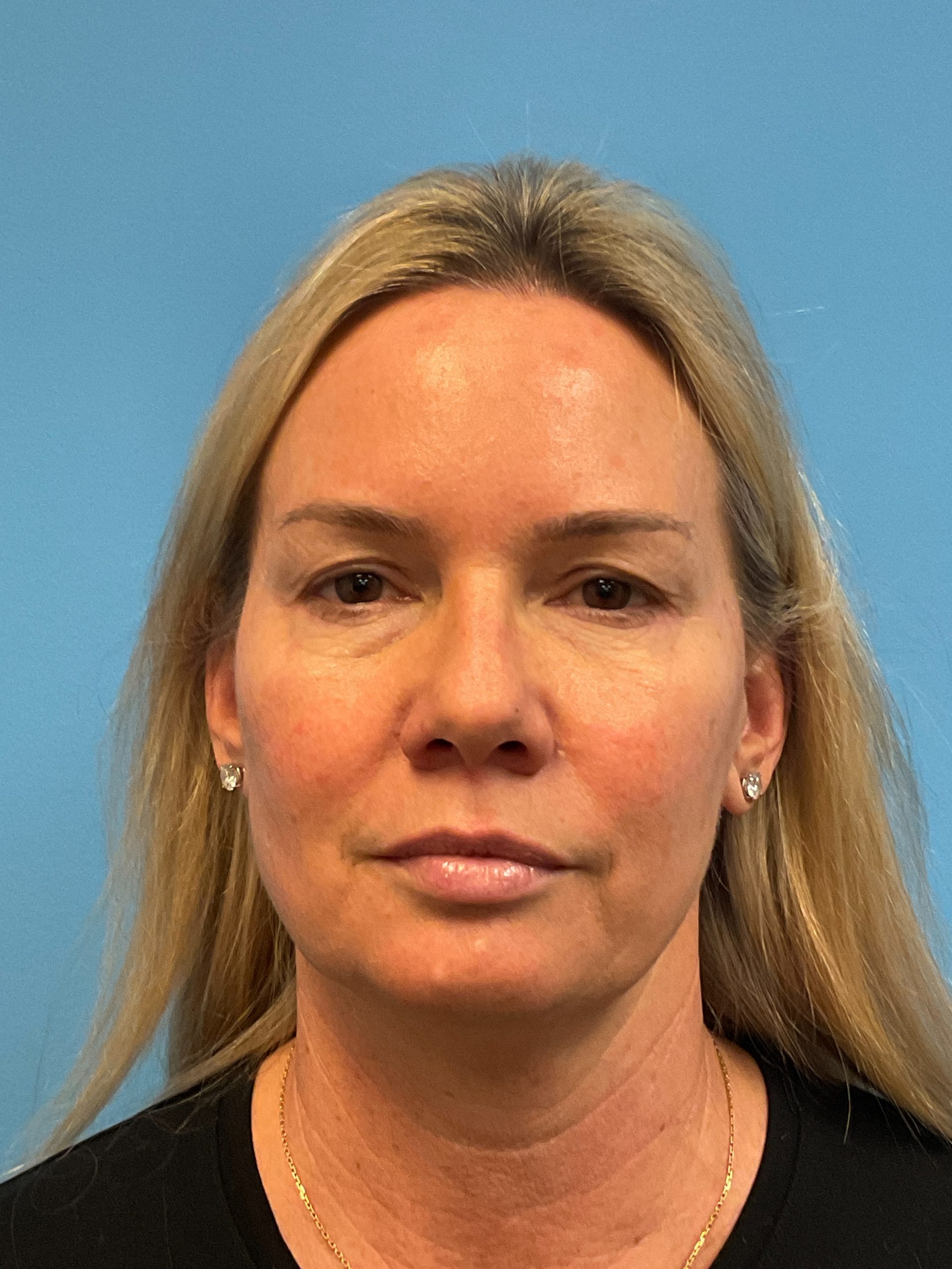 Facelift-Facial-Fat-Grafting-Necklift-Blepharoplasty-Case--9823 | Before Facelift 1